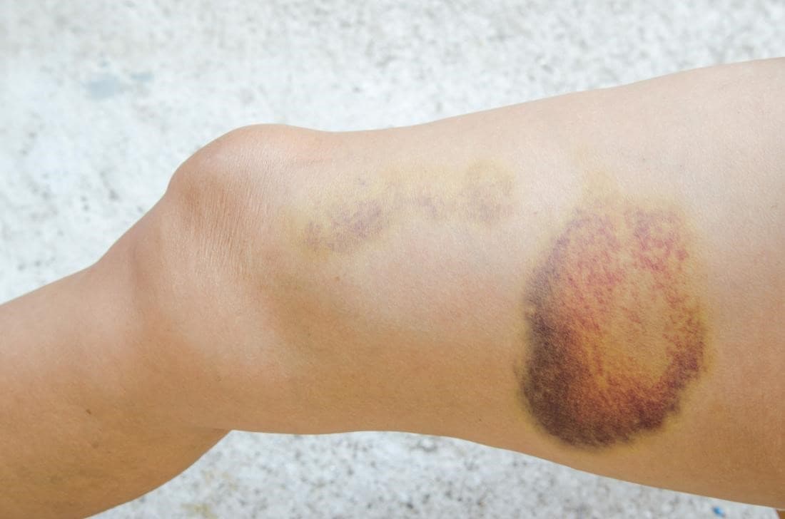Geltonai violetinė hematoma ant kojos prie kelio – sumušimo sukeltas kraujosruvos pavyzdys.