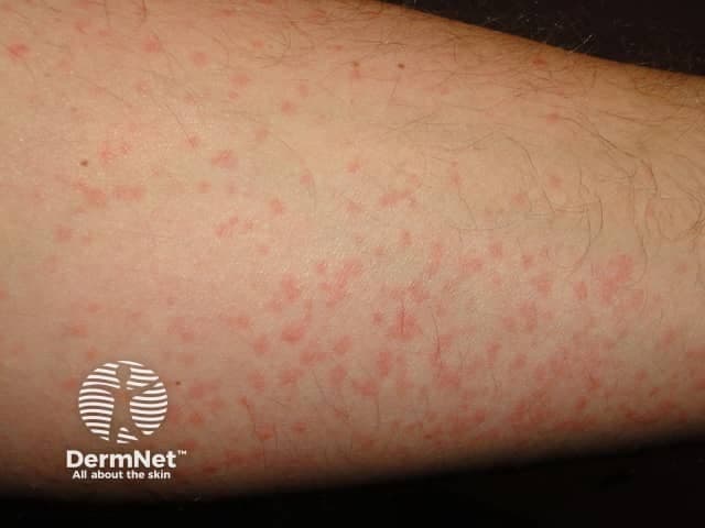Raudonų dėmelių ir pūkšlių bėrimas ant dilbio, būdingas šalčio sukeltai dilgėlinei (urtikarijai).