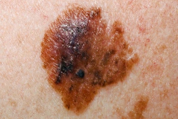 Didelis asimetriškas rudai juodas odos darinys su netaisyklingais kraštais ir spalvos kitimais, įtartinas dėl melanomos
