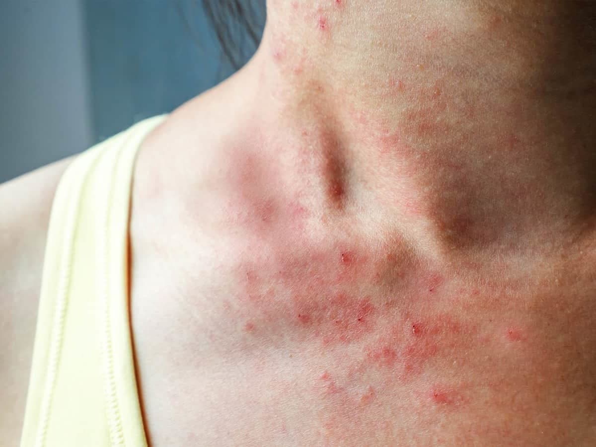 Paraudusi, niežtinti odos vieta su smulkiu bėrimu ant moters kaklo ir viršutinės krūtinės dalies