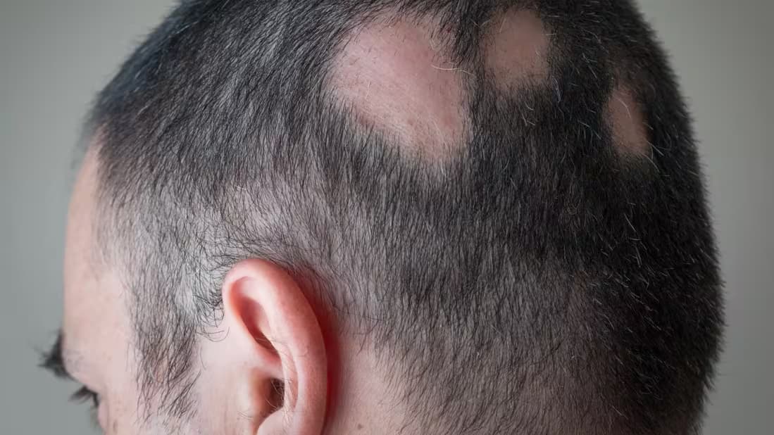 Žmogus su židinine alopecija (alopecia areata) – aiškiai matomi plikų lopų ploteliai galvos plaukuotoje dalyje