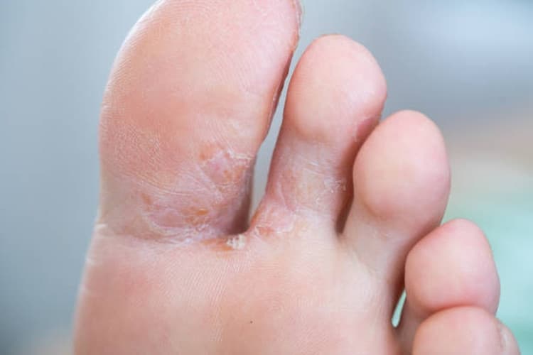 Besilupanti, šerpetojanti pado ir tarppirščių oda, būdinga pėdų grybeliui (tinea pedis)