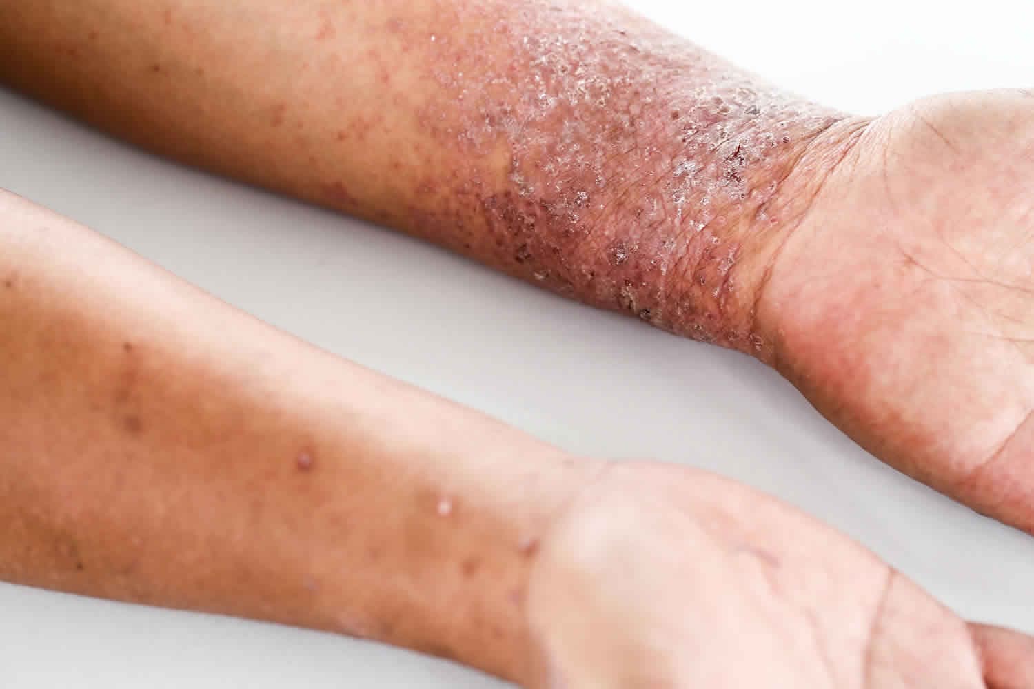 Atopinio dermatito pažeista paraudusi, šerpetojanti oda ant dilbio ir riešo