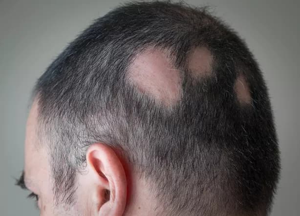 Keli apvalūs plaukų netekimo plotai vyro pakaušyje, būdingi židininei alopecijai