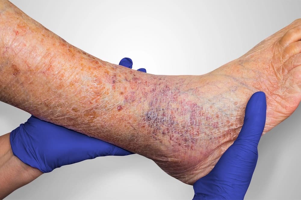 Pirštinėtomis rankomis apžiūrima blauzda su staziniam dermatitui būdinga rusva pigmentacija ir uždegimu