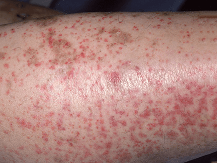 Blauzda, gausiai nusėta smulkiomis raudonai violetinėmis petechijomis – galimo vaskulito požymiai.