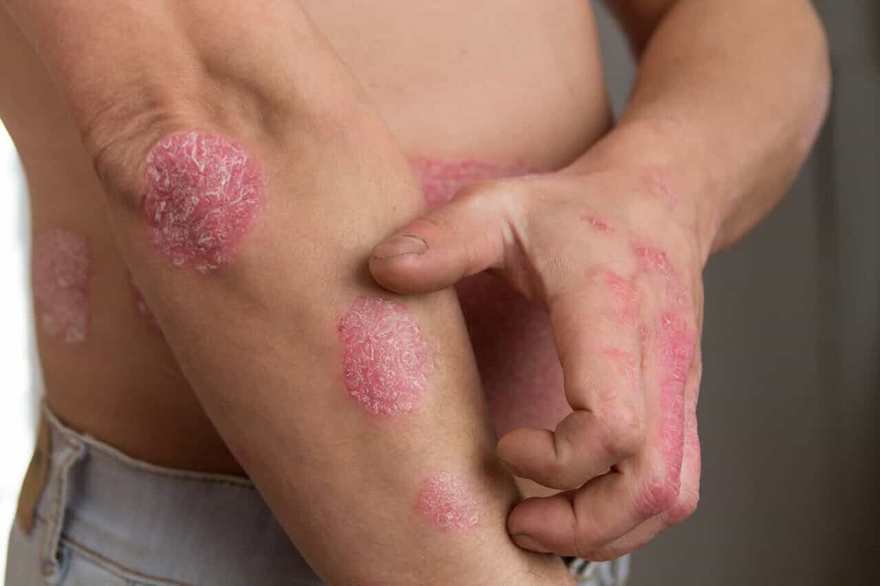 Žmogus kaso paraudusias, žvynuotas žvynelinės apnašas ant alkūnės ir rankų – reikalinga dermatologo pagalba.