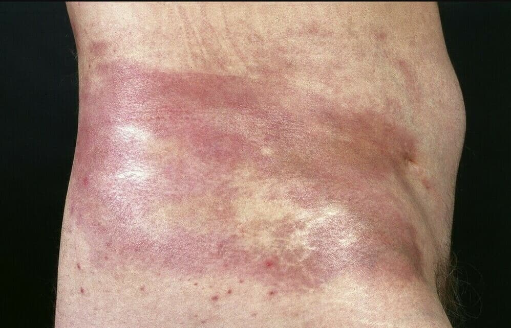 Plačios violetiškai paraudusios, sukietėjusios odos sritys ant liemens su lokalios sklerodermijos požymiais.