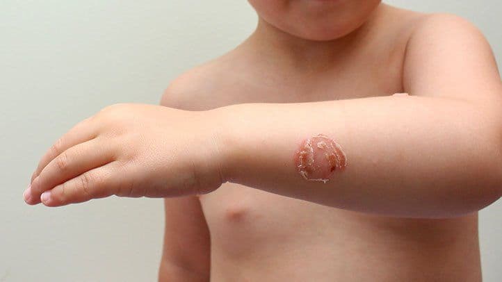 Pūslinė impetigos žaizda su gelsva pluta ant vaiko dilbio odos