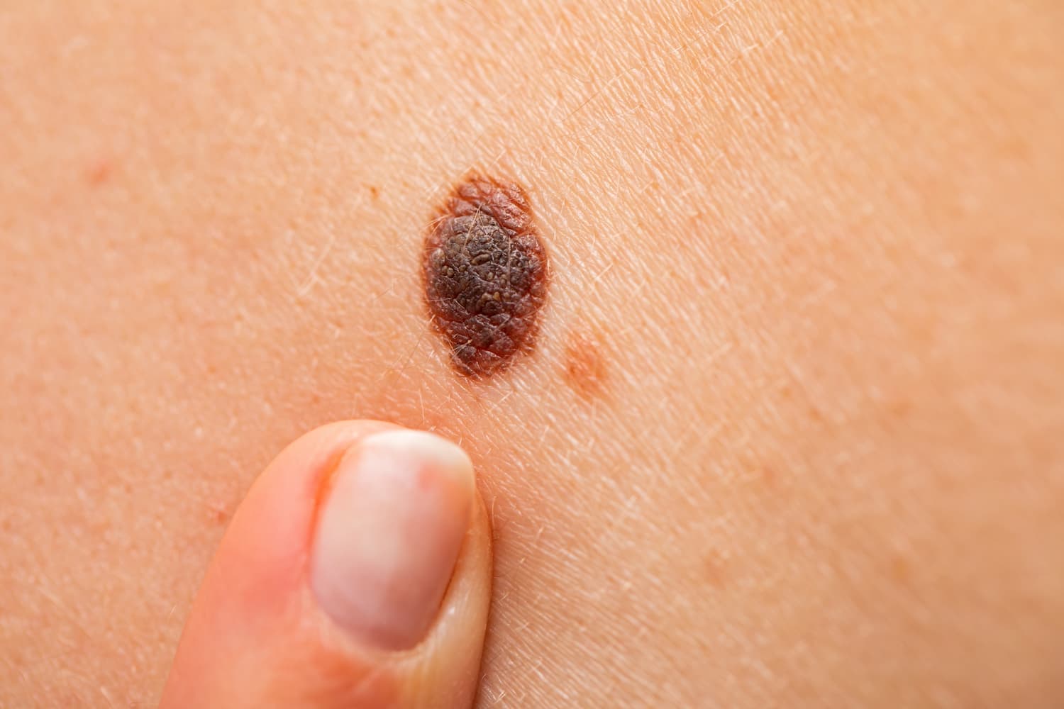 Iškilus tamsiai rudas melanocitinis apgamas ant odos, kurį dermatologas vertina dėl gerybiškumo.
