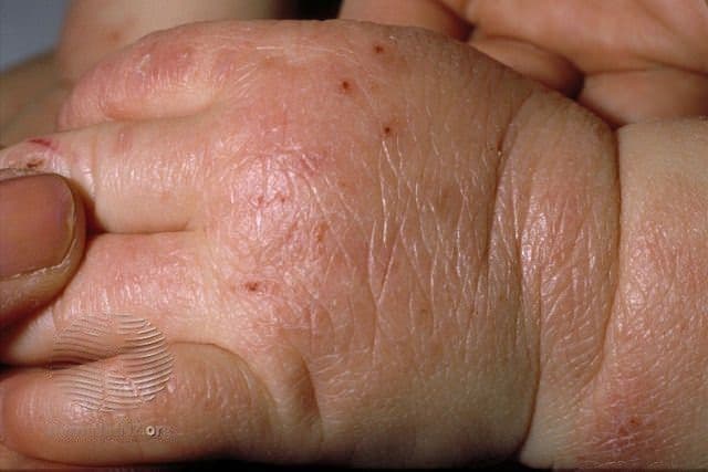 Vaiko plaštaka su sausa, šiurkščia ir parausvėjusia oda – atopinio dermatito požymiai ant rankos.
