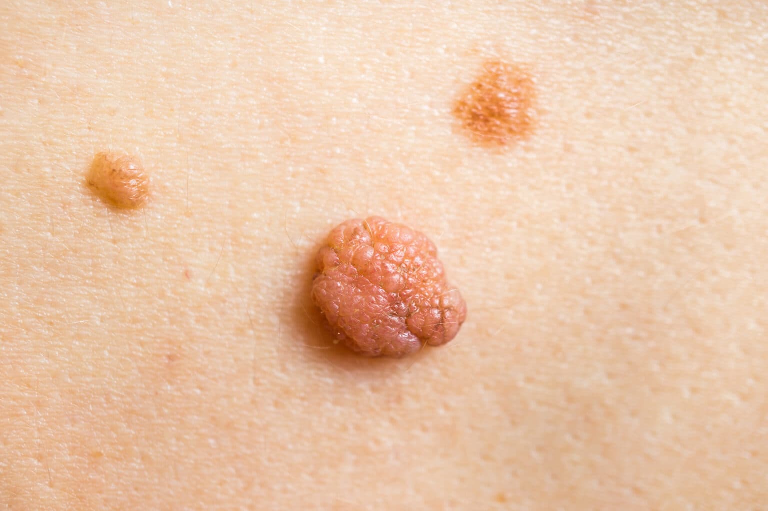 Iškili papiloma ir du pigmentiniai apgamai ant odos – dažni odos dariniai, vertinami dermatologo konsultacijos metu.